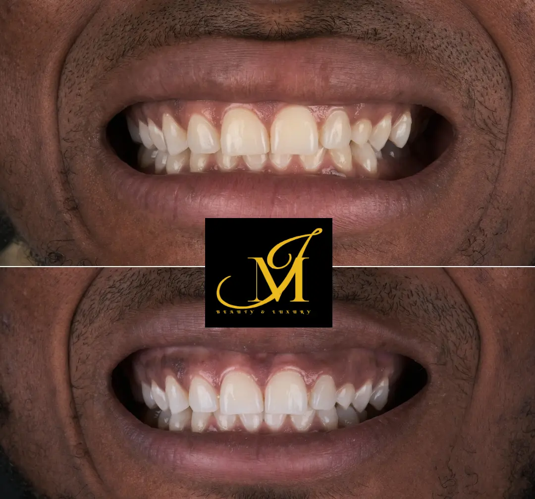 Duo dents blanches - N° JMBL003 - JosMir Beauty & Luxury